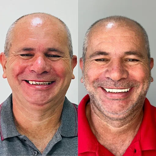 Comparação de sorriso antes e depois do tratamento com implantes