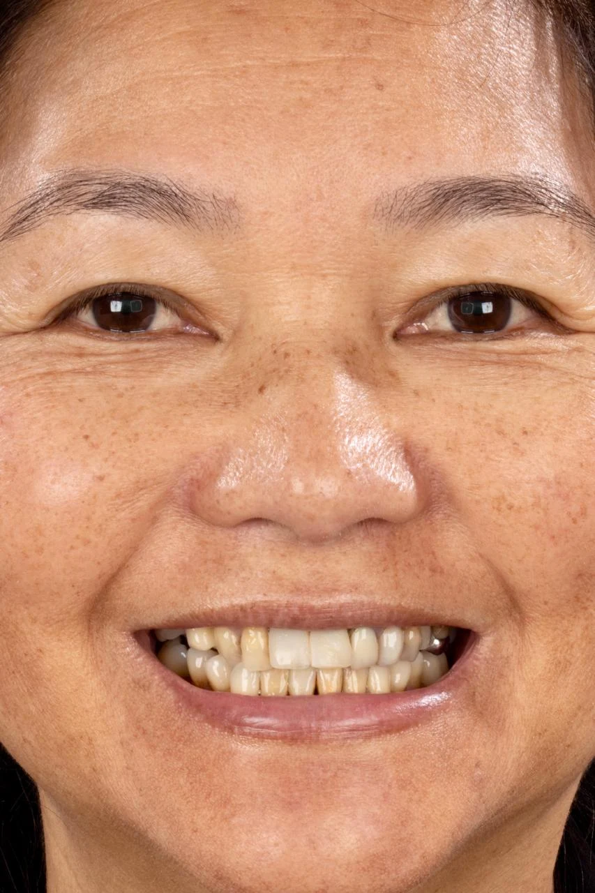 Sorriso da paciente antes do tratamento com facetas de porcelana