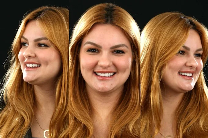 Paciente sorrindo após reabilitação do sorriso