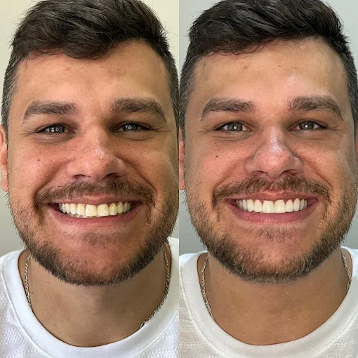 Comparação de sorriso antes e depois da reabilitação oral